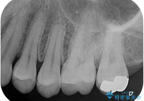 奥歯の虫歯をゴールドインレーで修復治療の治療後