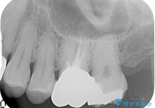 目立つ銀歯を白くしたい　銀歯からセラミックへの再補綴の治療前