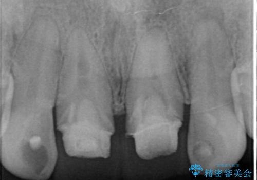 [前歯　オールセラミック治療]  前歯に天然歯のような透明感を創るの治療前