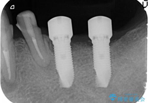 下顎大臼歯欠損　インプラントによる咬合機能回復の治療中
