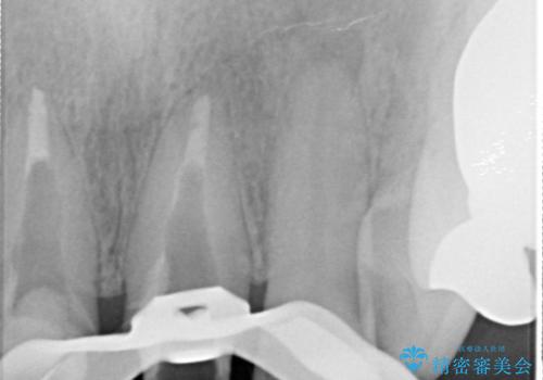 [前歯　オールセラミック治療]  前歯に天然歯のような透明感を創るの治療中