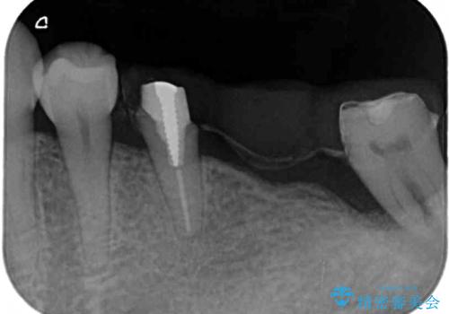 奥歯が抜けそう　部分矯正による咬み合わせの改善とインプラントによる補綴治療の治療前