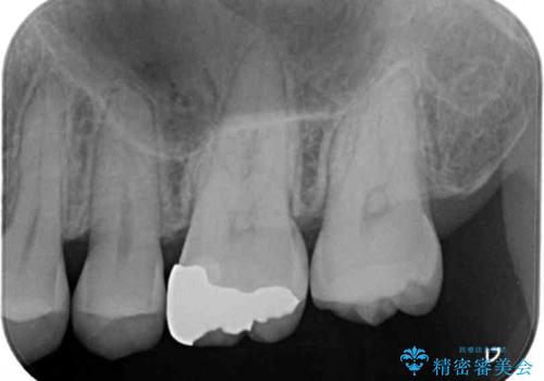 正面から見える奥の銀歯 セラミックインレーで改善の治療前
