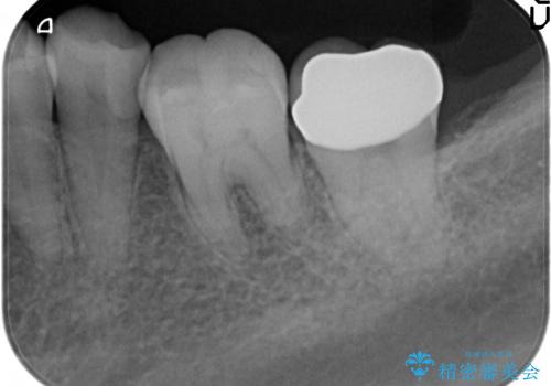 オールセラミッククラウン　奥歯の虫歯治療の治療後