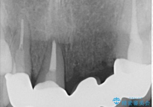 前歯のセラミックブリッジ　長すぎる前歯を部分矯正で修正するの治療後