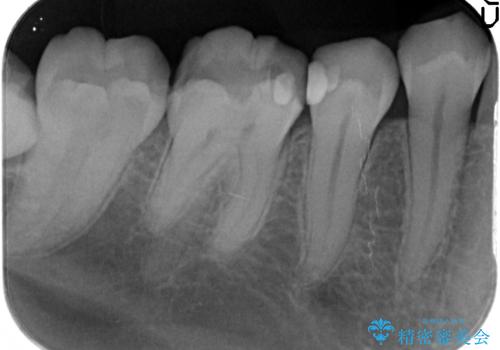 メタルボンドクラウン　PGA(ゴールド)インレー　虫歯治療の治療前
