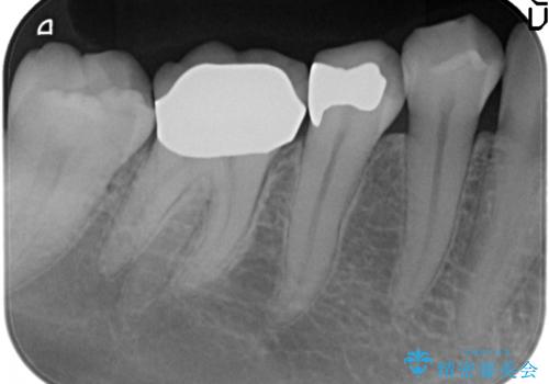 メタルボンドクラウン　PGA(ゴールド)インレー　虫歯治療の治療後