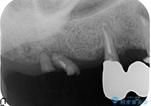 奥歯で噛めない　インプラントとセラミックによる咬み合わせの回復の治療前