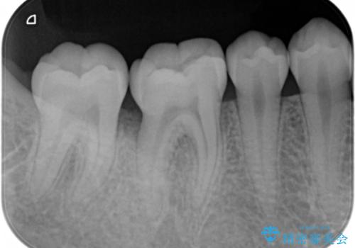 侵襲性歯周炎によるシビアな骨欠損　再生治療で回復の治療後