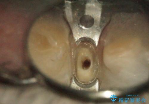 下の前歯　虫歯で神経が死んでしまった　根管治療から被せものまでの治療中