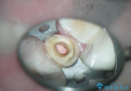 前歯のセラミックブリッジ　長すぎる前歯を部分矯正で修正するの治療中