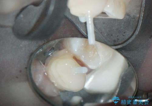 前歯のセラミックブリッジ　長すぎる前歯を部分矯正で修正するの治療中