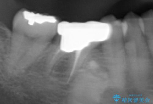 銀歯のやり直し　セラミックで奥歯をきれいにの治療前