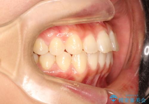 インビザラインで前歯のデコボコを目立たず矯正の治療後