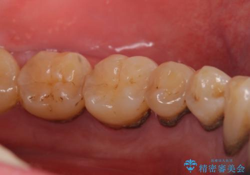 歯の周り、歯肉の中に付着していた歯石を超音波にて除去の治療前