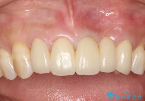 前歯のセラミックブリッジ　長すぎる前歯を部分矯正で修正するの治療後