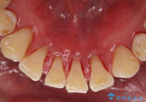 歯の周り、歯肉の中に付着していた歯石を超音波にて除去の治療後