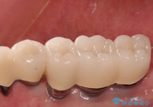 奥歯で噛めない　インプラントとセラミックによる咬み合わせの回復の治療後