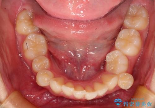 前歯のがたがた　出っ歯が気になる　永久歯が一本足りない変則的な治療の治療前