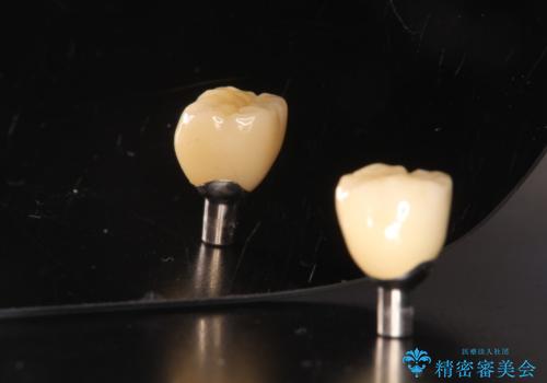 ショートインプラントによる奥歯の咬み合わせの回復治療