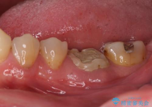 奥歯の割れてしまった歯　ストローマンインプラントによる咬合回復の治療前