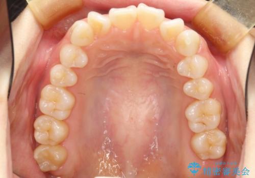 前歯の出っ歯とでこぼこを抜歯矯正で改善　目立たないワイヤー矯正の治療前