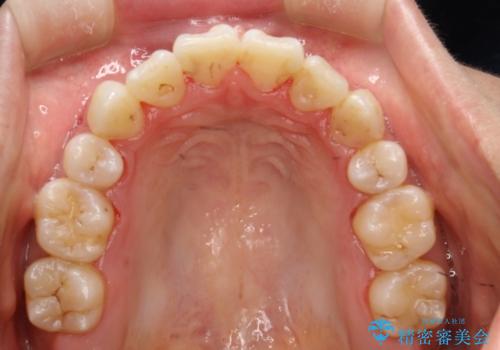 ハーフリンガルによる八重歯の治療　3incisor(3本前歯)症例の治療後