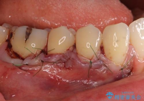 歯根の露出を隠したい　歯肉移植による根面被覆の治療中
