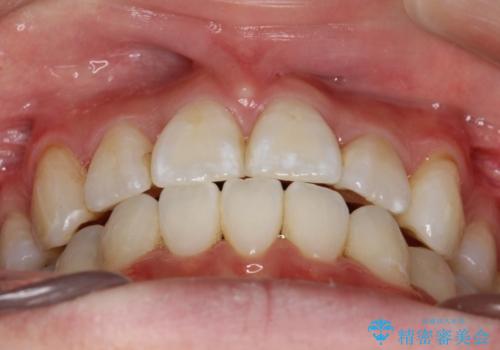 ハーフリンガルによる八重歯の治療　3incisor(3本前歯)症例の治療後