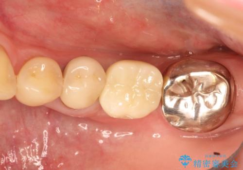 ショートインプラントによる奥歯の咬み合わせの回復治療の治療後