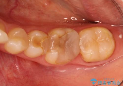 劣化した詰め物と虫歯の治療の治療前