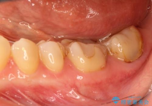 劣化した詰め物と虫歯の治療の治療前