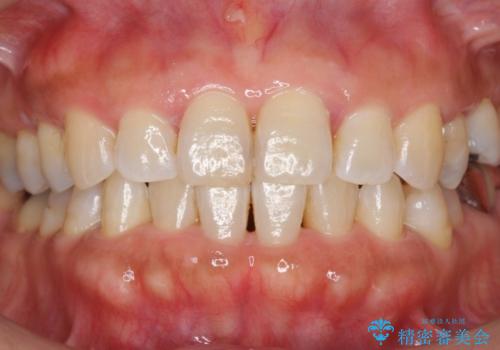 歯の黄ばみをホワイトニングで白くの治療前