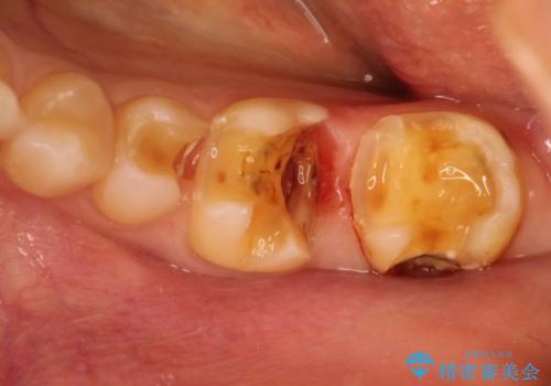 劣化した詰め物と虫歯の治療の治療中