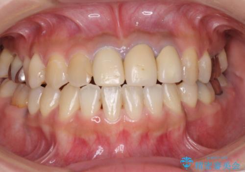 きれいな白い歯をいれたい　前歯の補綴治療前のホワイトニングの治療前