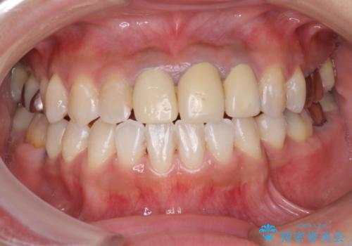 きれいな白い歯をいれたい　前歯の補綴治療前のホワイトニングの治療中