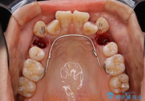 ハーフリンガルによる八重歯の治療　3incisor(3本前歯)症例の治療中