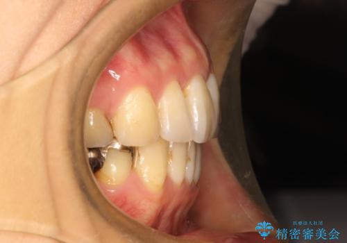 ハーフリンガル ワイヤー矯正　出っ歯の矯正治療の治療後