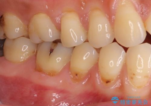 歯根の露出を隠したい　歯肉移植による根面被覆の治療前