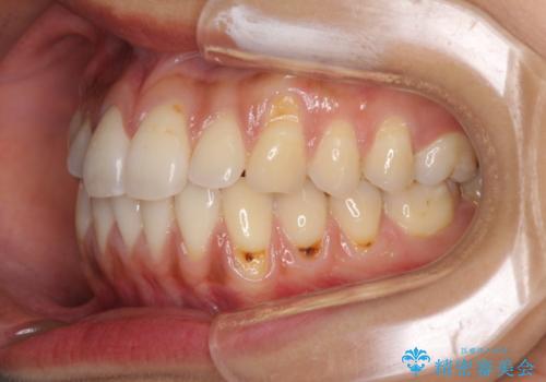歯根の露出を隠したい　歯肉移植による根面被覆の治療前