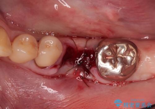 ショートインプラントによる奥歯の咬み合わせの回復治療の治療中