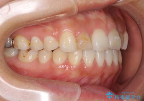 前歯の歯並びと変色を改善　インビザラインとオールセラミックの治療中