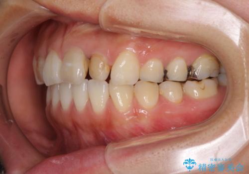 前歯の歯並びと変色を改善　インビザラインとオールセラミックの治療中