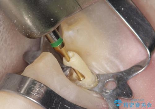 下の前歯　虫歯で神経が死んでしまった　根管治療から被せものまでの治療中