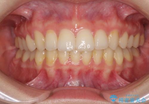 前歯のがたがた　出っ歯が気になる　永久歯が一本足りない変則的な治療の治療後