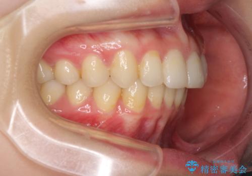 前歯のがたがた　出っ歯が気になる　永久歯が一本足りない変則的な治療の治療後
