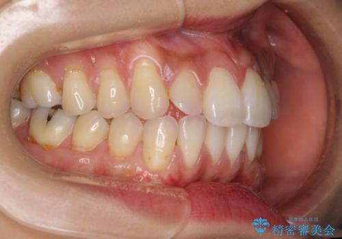 歯根の露出を隠したい　歯肉移植による根面被覆の治療後