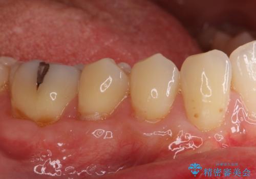 歯根の露出を隠したい　歯肉移植による根面被覆の治療後