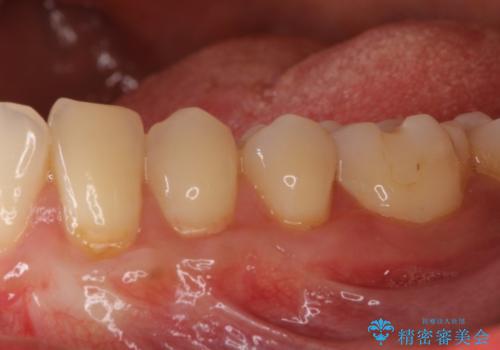 歯根の露出を隠したい　歯肉移植による根面被覆
