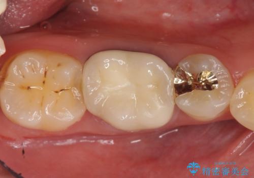 メタルボンドクラウン　PGA(ゴールド)インレー　虫歯治療の治療後